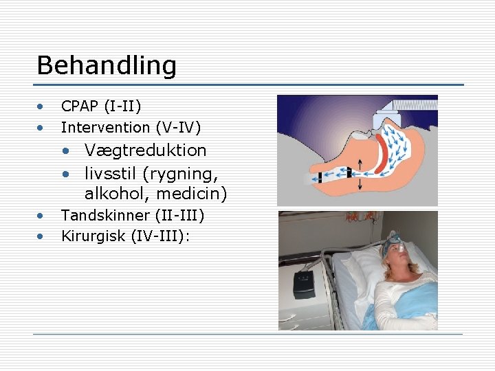 Behandling • • CPAP (I-II) Intervention (V-IV) • Vægtreduktion • livsstil (rygning, alkohol, medicin)