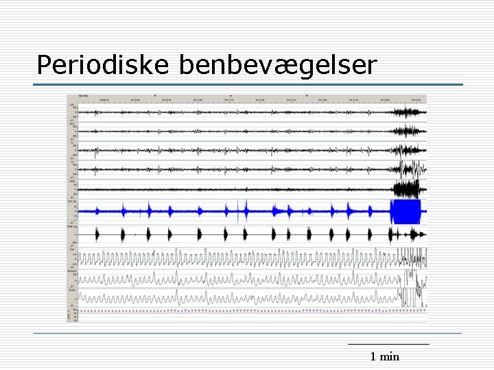 Periodiske benbevægelser 1 min 