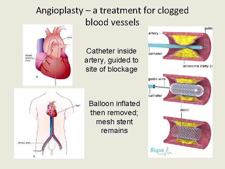 Angioplasty – a treatment for clogged blood vessels Catheter inside artery, guided to site