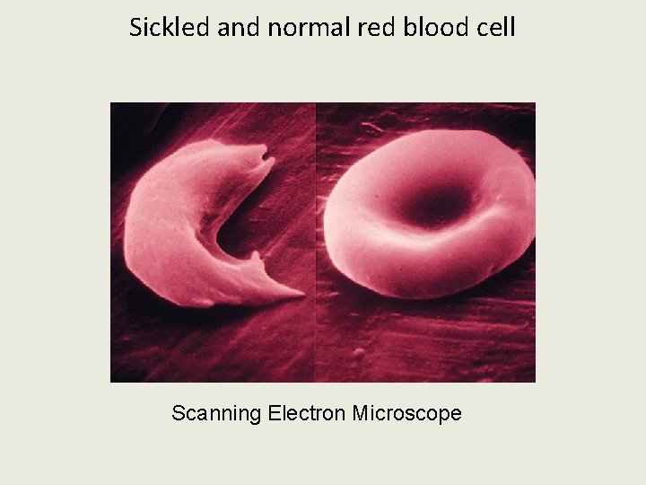 Sickled and normal red blood cell Scanning Electron Microscope 