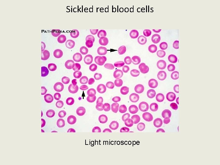 Sickled red blood cells Light microscope 