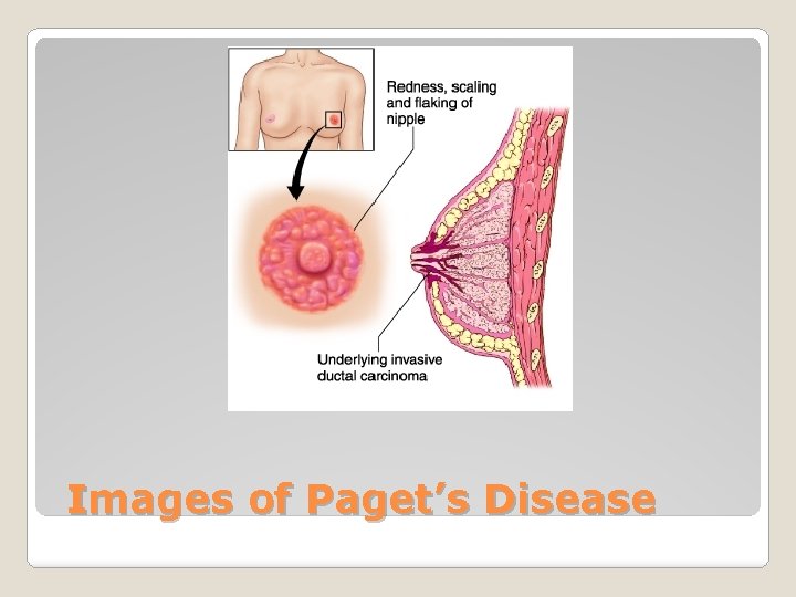 Images of Paget’s Disease 