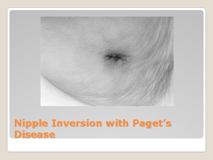 Nipple Inversion with Paget’s Disease 
