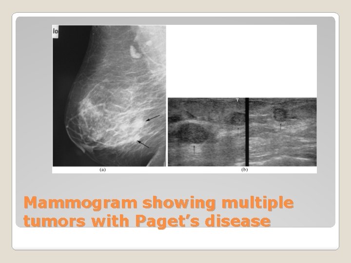 Mammogram showing multiple tumors with Paget’s disease 
