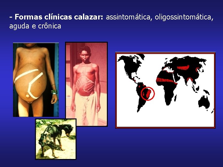 - Formas clínicas calazar: assintomática, oligossintomática, aguda e crônica 