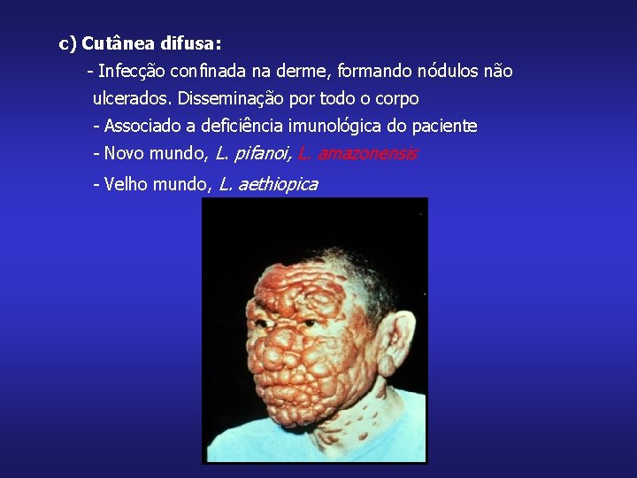 c) Cutânea difusa: - Infecção confinada na derme, formando nódulos não ulcerados. Disseminação por