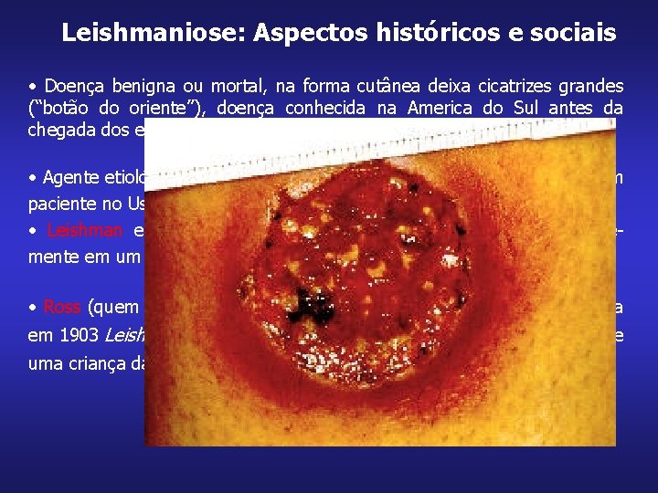 Leishmaniose: Aspectos históricos e sociais • Doença benigna ou mortal, na forma cutânea deixa