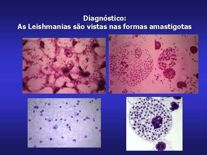 Diagnóstico: As Leishmanias são vistas nas formas amastigotas 