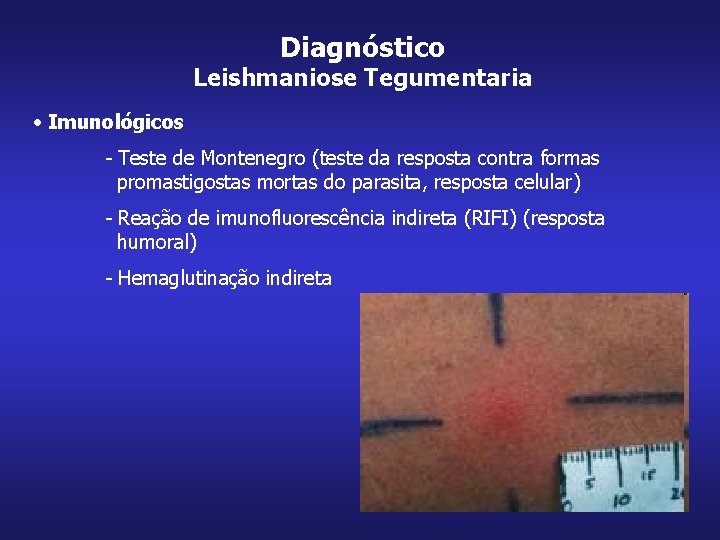 Diagnóstico Leishmaniose Tegumentaria • Imunológicos - Teste de Montenegro (teste da resposta contra formas