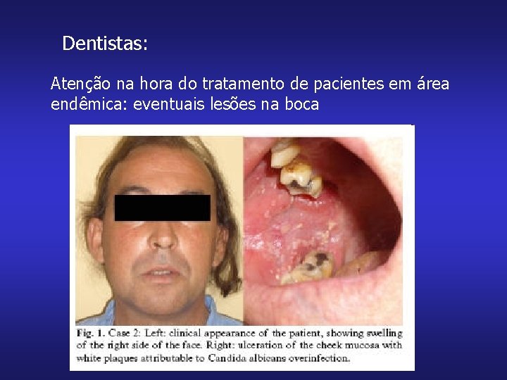 Dentistas: Atenção na hora do tratamento de pacientes em área endêmica: eventuais lesões na