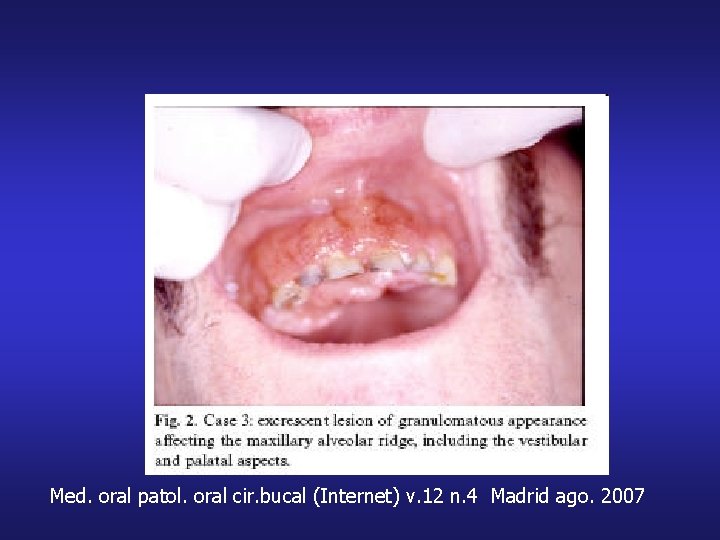 Med. oral patol. oral cir. bucal (Internet) v. 12 n. 4 Madrid ago. 2007