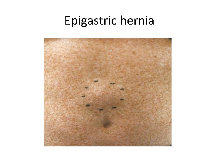 Epigastric hernia 