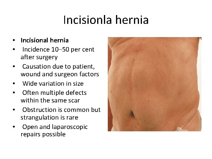 Incisionla hernia • Incisional hernia • Incidence 10– 50 per cent after surgery •