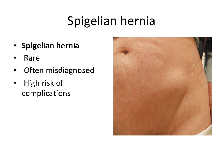 Spigelian hernia • • Spigelian hernia Rare Often misdiagnosed High risk of complications 