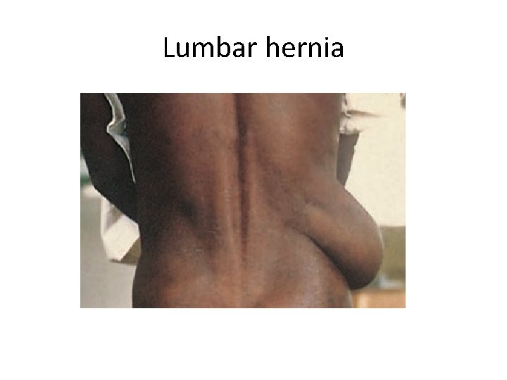 Lumbar hernia 