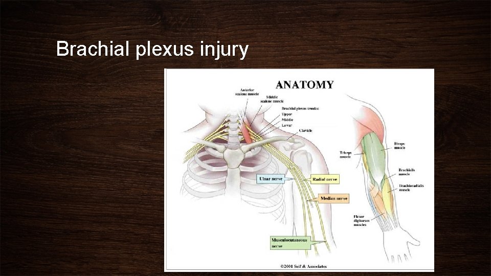 Brachial plexus injury 