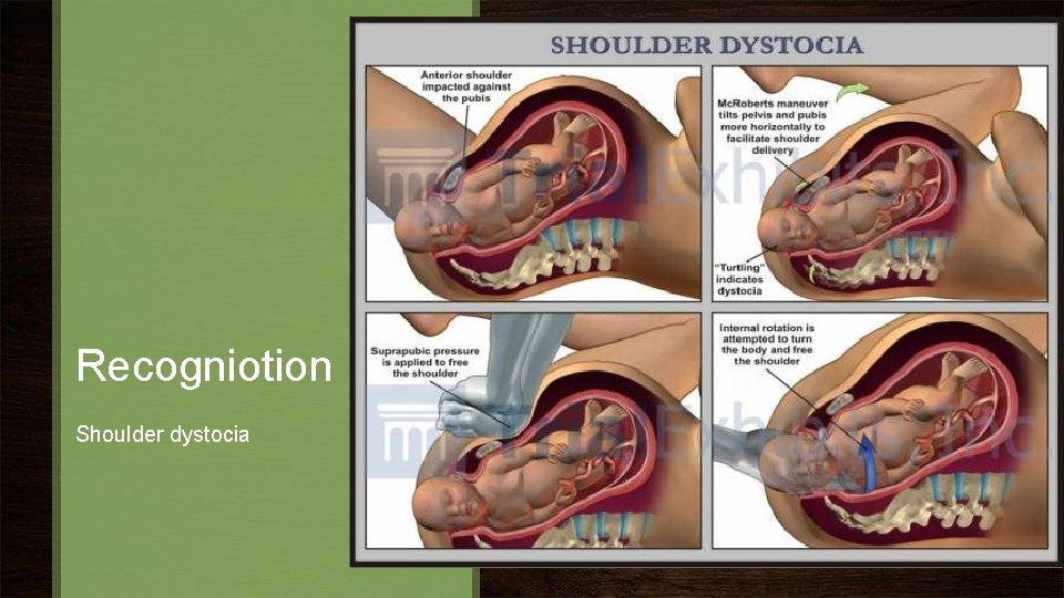 Recogniotion Shoulder dystocia 