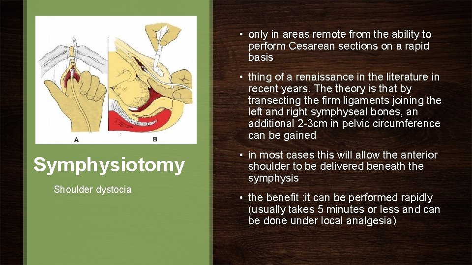  • only in areas remote from the ability to perform Cesarean sections on