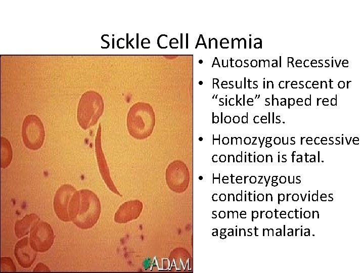 Sickle Cell Anemia • Autosomal Recessive • Results in crescent or “sickle” shaped red
