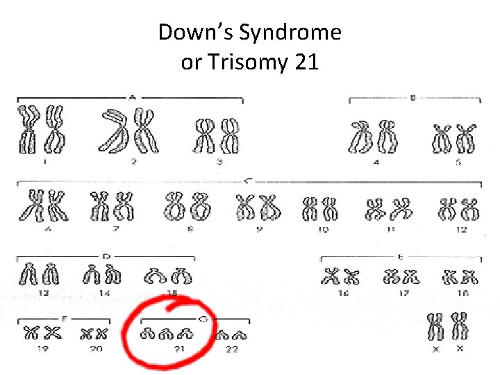 Down’s Syndrome or Trisomy 21 