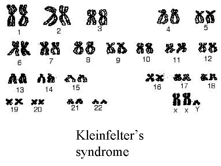 Kleinfelter’s syndrome 