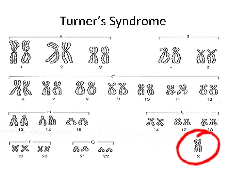 Turner’s Syndrome 
