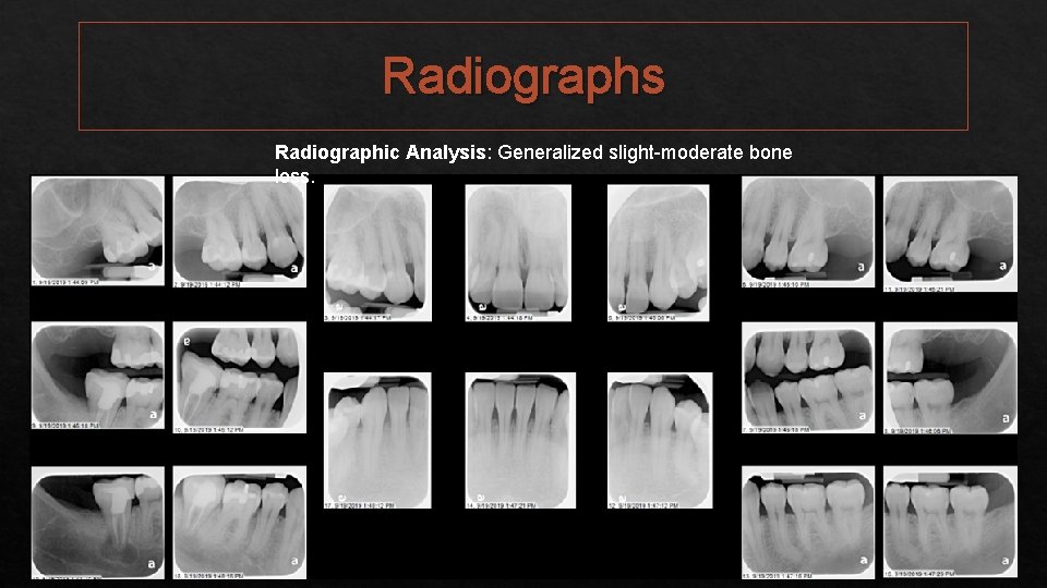 Radiographs Radiographic Analysis: Generalized slight-moderate bone loss. 