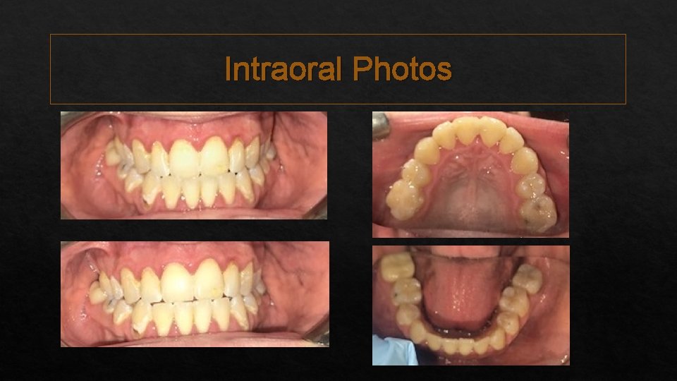 Intraoral Photos 