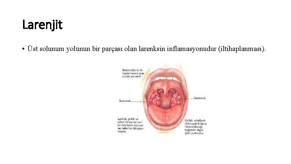 Larenjit • Üst solunum yolunun bir parçası olan larenksin inflamasyonudur (iltihaplanması). 