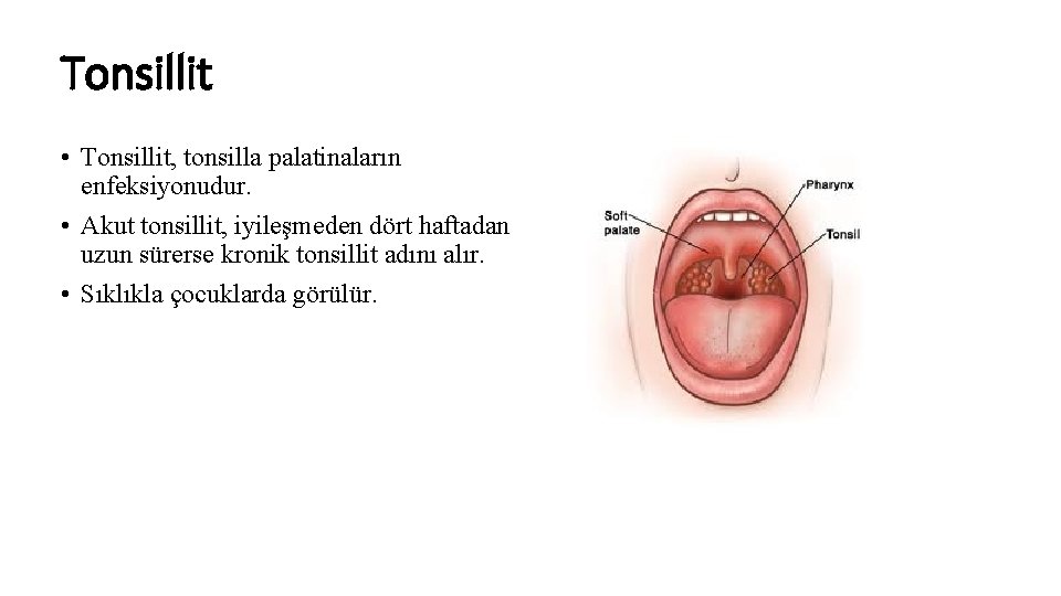 Tonsillit • Tonsillit, tonsilla palatinaların enfeksiyonudur. • Akut tonsillit, iyileşmeden dört haftadan uzun sürerse