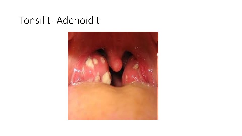 Tonsilit- Adenoidit 