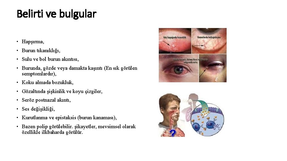 Belirti ve bulgular • Hapşırma, • Burun tıkanıklığı, • Sulu ve bol burun akıntısı,