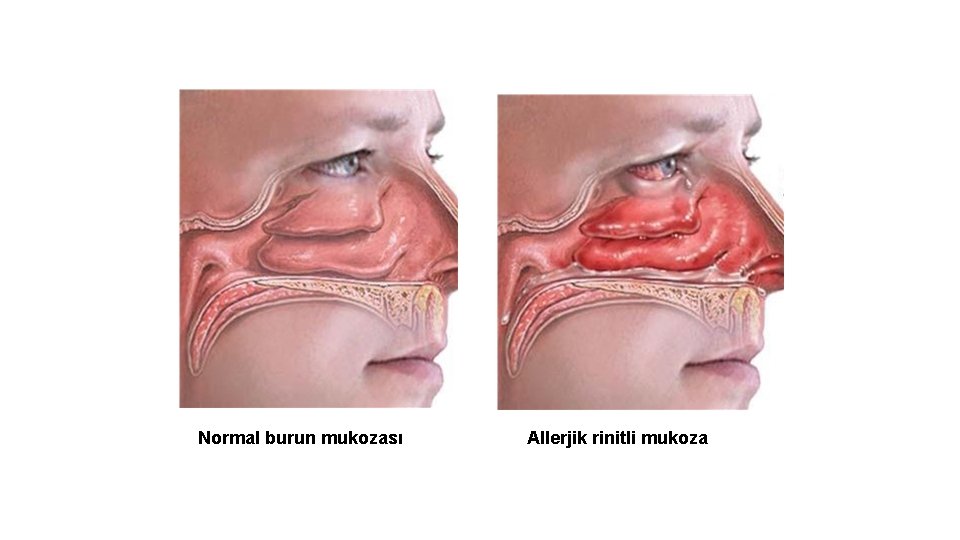 Normal burun mukozası Allerjik rinitli mukoza 