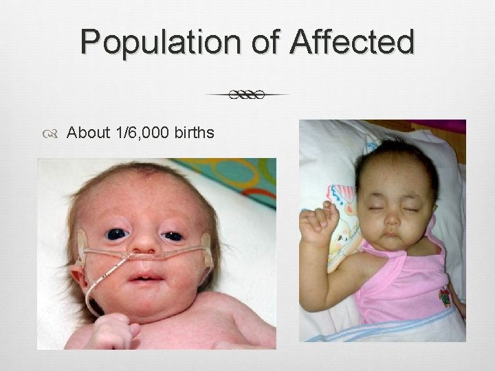 Population of Affected About 1/6, 000 births 