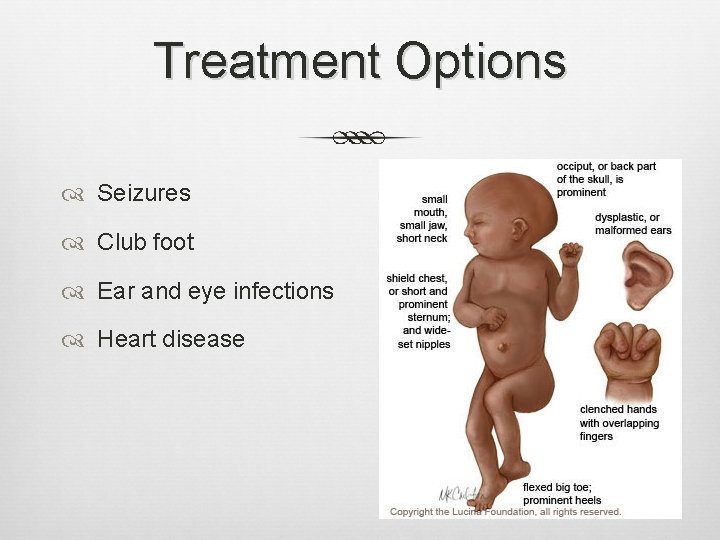 Treatment Options Seizures Club foot Ear and eye infections Heart disease 