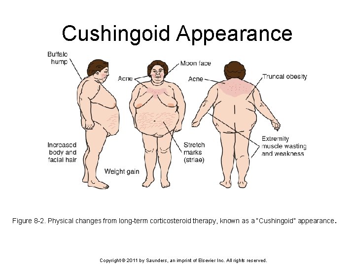Cushingoid Appearance Figure 8 -2. Physical changes from long-term corticosteroid therapy, known as a