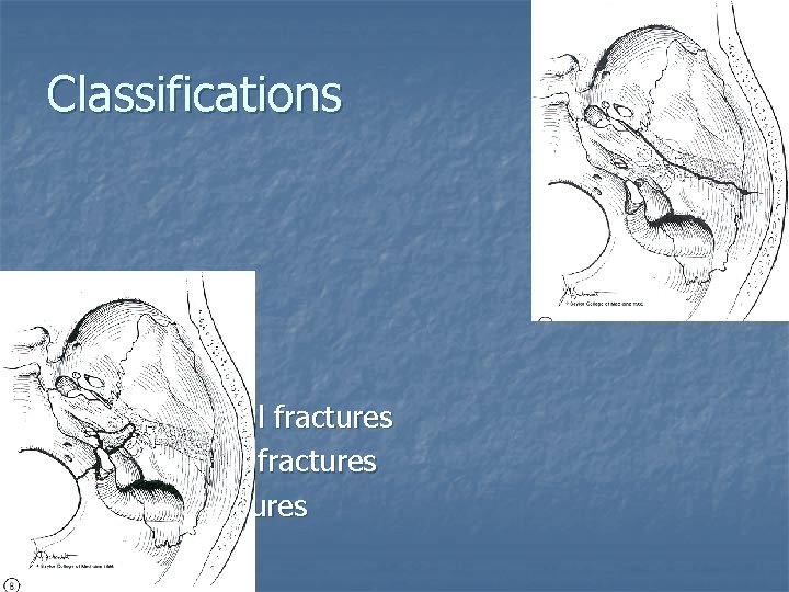 Classifications 1. 2. 3. Longitudinal fractures Transverse fractures Mixed fractures 