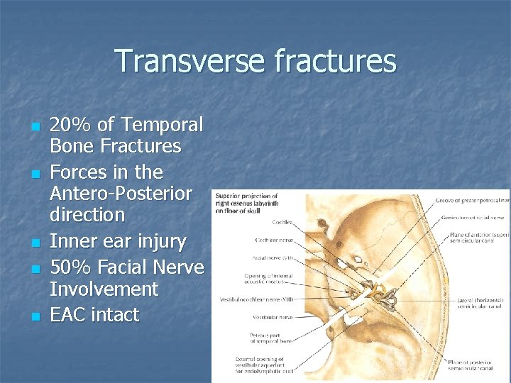 Transverse fractures n n n 20% of Temporal Bone Fractures Forces in the Antero-Posterior