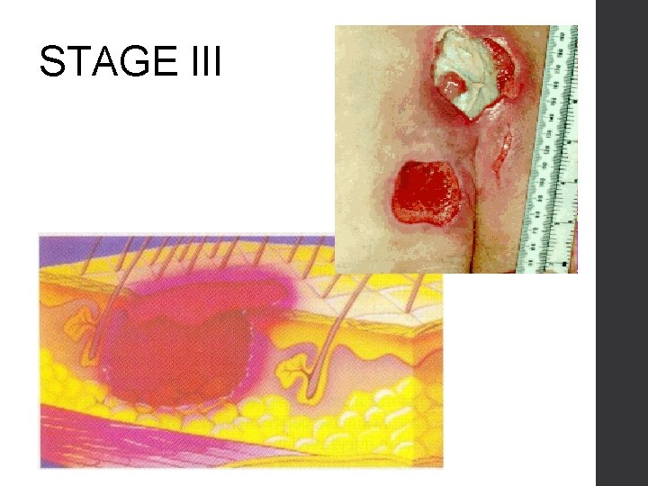 STAGE III 
