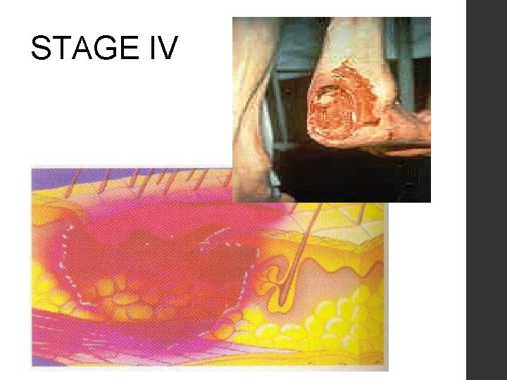 STAGE IV 