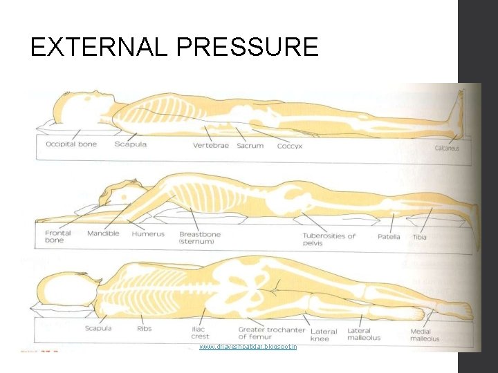 EXTERNAL PRESSURE www. drjayeshpatidar. blogspot. in 