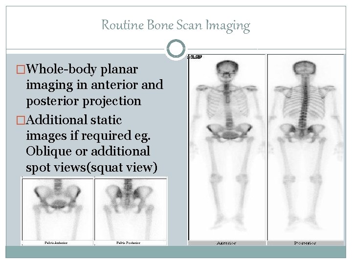 Routine Bone Scan Imaging �Whole-body planar imaging in anterior and posterior projection �Additional static