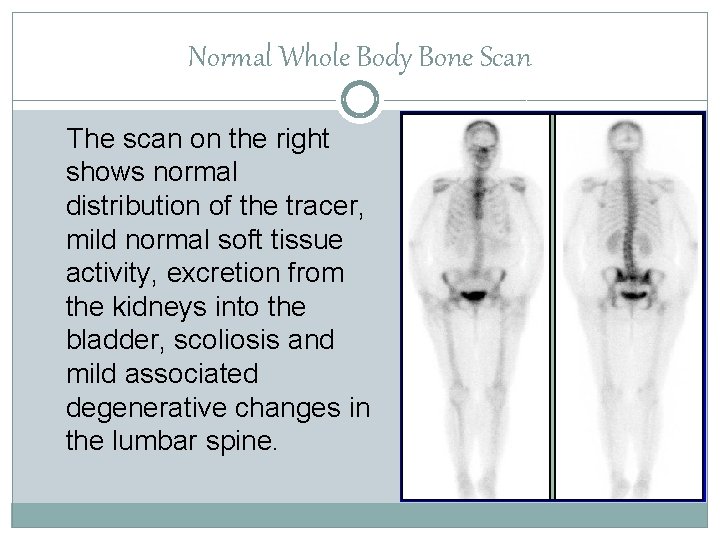 Normal Whole Body Bone Scan The scan on the right shows normal distribution of