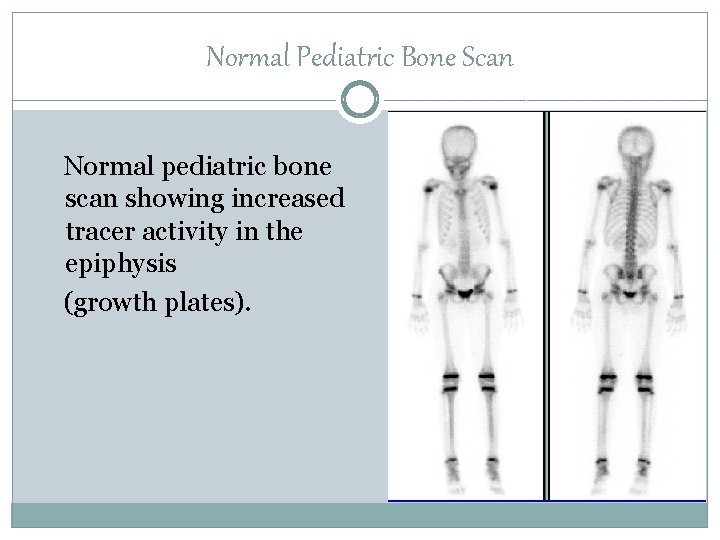 Normal Pediatric Bone Scan Normal pediatric bone scan showing increased tracer activity in the