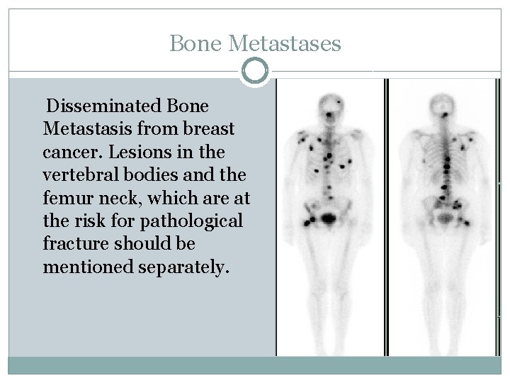 Bone Metastases Disseminated Bone Metastasis from breast cancer. Lesions in the vertebral bodies and