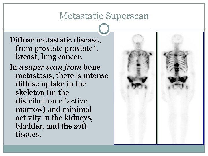 Metastatic Superscan Diffuse metastatic disease, from prostate*, breast, lung cancer. In a super scan