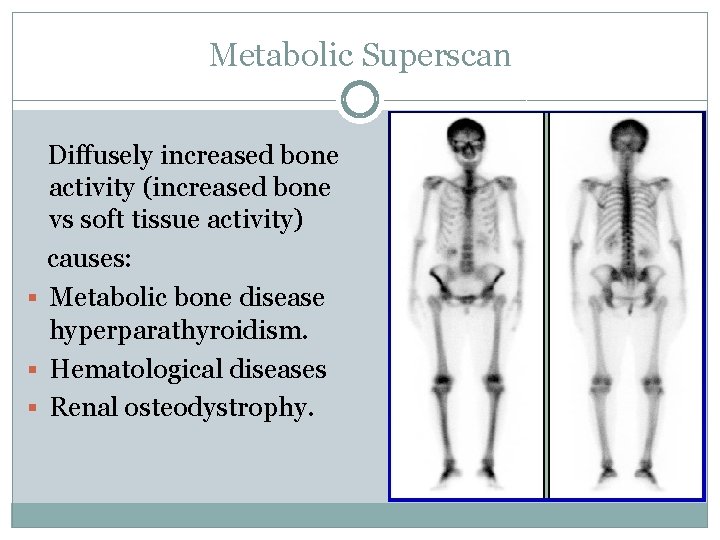 Metabolic Superscan Diffusely increased bone activity (increased bone vs soft tissue activity) causes: §