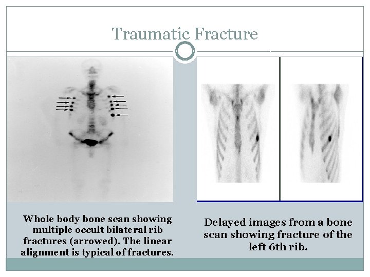 Traumatic Fracture Whole body bone scan showing multiple occult bilateral rib fractures (arrowed). The