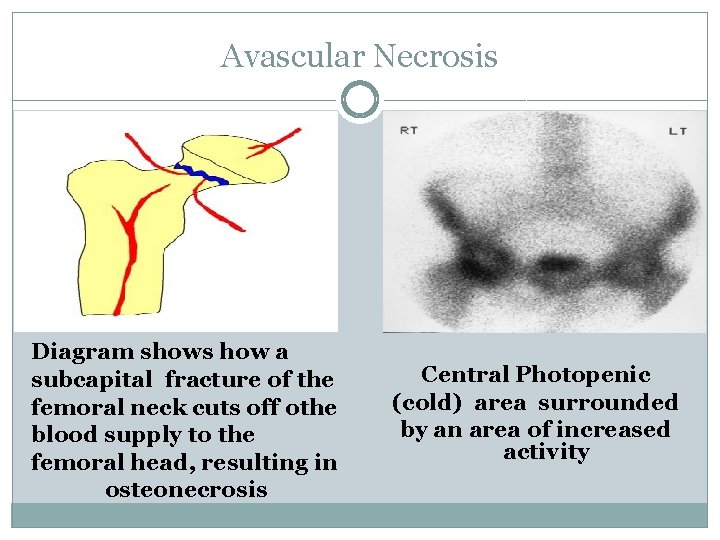 Avascular Necrosis Diagram shows how a subcapital fracture of the femoral neck cuts off