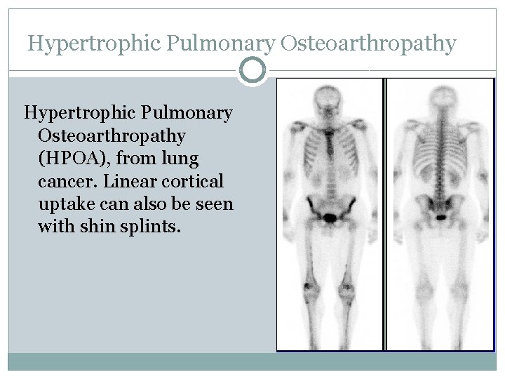 Hypertrophic Pulmonary Osteoarthropathy (HPOA), from lung cancer. Linear cortical uptake can also be seen